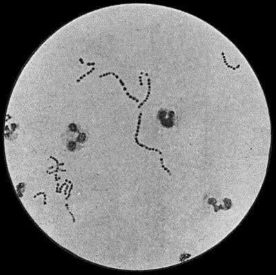 Fig. 3.—Streptococci in Pus from an acute abscess in subcutaneous tissue. × 1000 diam. Gram's stain.