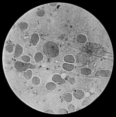 Fig. 5.—Fraenkel's Pneumococci in Pus from Empyema following Pneumonia. × 100 diam. Stained with Muir's capsule stain.