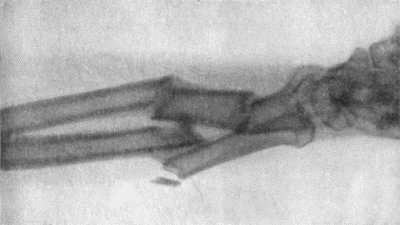 Fig. 2.—Radiogram of Comminuted Fracture of both Bones of Forearm.