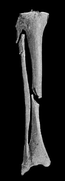 Fig. 3.—Showing (1) Oblique fracture of Tibia; (2) Oblique fracture with partial separation of Epiphysis of upper end of Fibula; (3) Incomplete fracture of Fibula in upper third. Result of railway accident. Boy æt. 16.