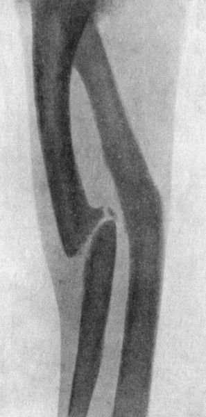 Fig. 6.—Radiogram of Un-united Fracture of Shaft of Ulna of fifteen years' duration.