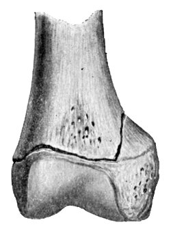 Fig. 8.—Partial Separation of Epiphysis, with Fracture running into Diaphysis.