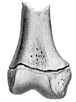 Fig. 9.—Complete Separation of Epiphysis.