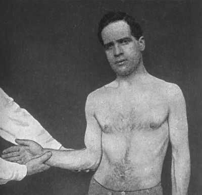 Fig. 20.—Kocher's Method of reducing Sub-coracoid Dislocation—First Movement; Rotation of Arm away from Middle Line.