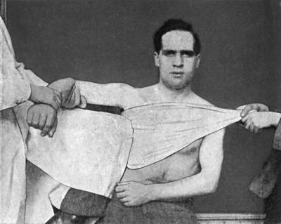 Fig. 23.—Miller's Method of reducing Sub-coracoid Dislocation—First Movement.