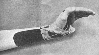 Fig. 31.—“Cock-up” Splint, for maintaining Dorsiflexion at Wrist.