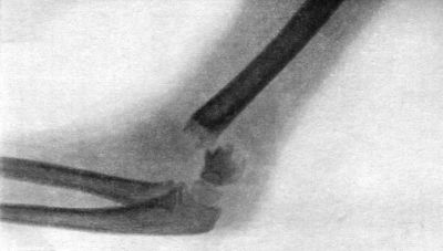 Fig. 33.—Radiogram of Supra-condylar Fracture of Humerus, in a child æt. 7.