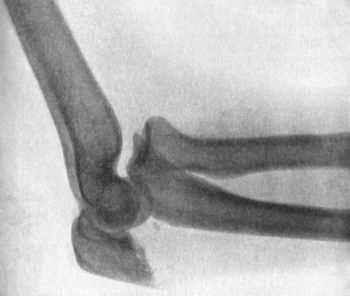 Fig. 39.—Forward Dislocation of Elbow, with Fracture of Olecranon.