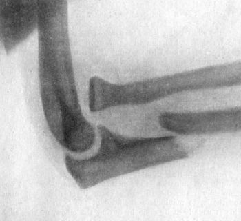 Fig. 40.—Radiogram of Forward Dislocation of Head of Radius, with Fracture of Shaft of Ulna.