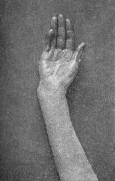 Fig. 43.—Colles' Fracture showing radial deviation of hand.