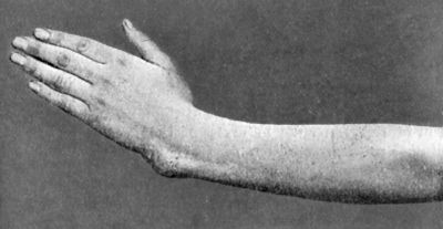 Fig. 48.—Manus Valga following separation of lower radial epiphysis in childhood.