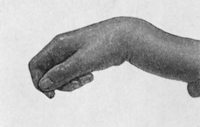 Fig. 50.—Dorsal Dislocation of Wrist at Radio-carpal Articulation, in a man, æt. 24, from a fall.