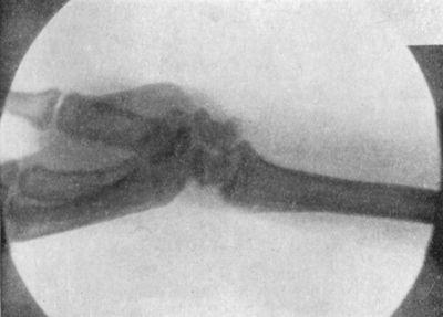 Fig. 51.—Radiogram showing Forward Dislocation of Navicular (Scaphoid) Bone.