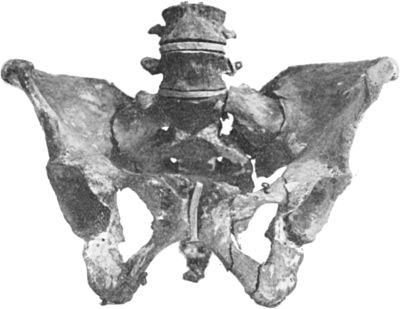 Fig. 55.—Multiple Fracture of Pelvis through Horizontal and Descending Rami of both Pubes, and Longitudinal Fracture of left side of Sacrum.