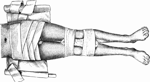 Fig. 57.—Many-tailed Bandage and Binder for Fracture of Pelvic Girdle.