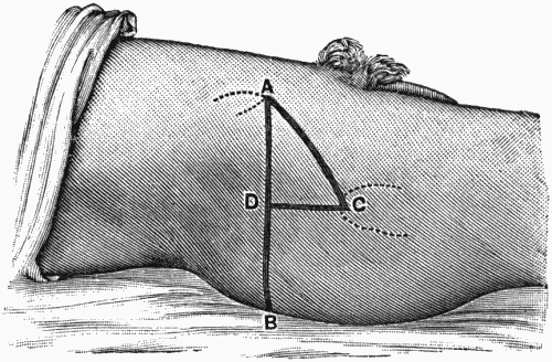 Fig. 59.—Bryant's Line.