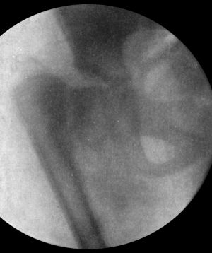 Fig. 65.—Coxa Vara following Fracture of Neck of Femur in a child.