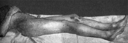 Fig. 72.—Dislocation of Right Femur on to Dorsum Ilii.