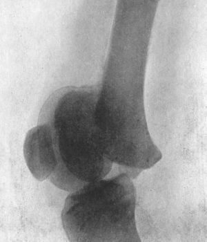 Fig. 82.—Radiogram of Separation of Lower Epiphysis of Femur, with backward displacement of the diaphysis; pressure on popliteal vessels caused sloughing of calf.