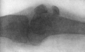 Fig. 87.—Radiogram of Fracture of Patella.