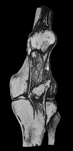 Fig. 88.—Fracture of Patella, showing wide separation of fragments, which are united by a fibrous band.