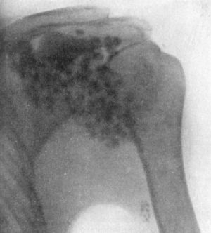 Fig. 105.—Radiogram showing Multiple partially ossified Cartilaginous Loose Bodies in Shoulder-joint. The lowest one is in the synovial prolongation along the tendon of the biceps.