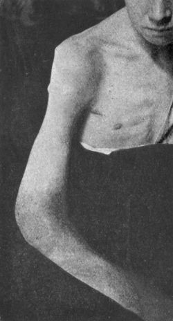 Fig. 106.—Diffuse Tuberculous Thickening of Synovial Membrane of Elbow (white swelling) in a boy æt. 12.