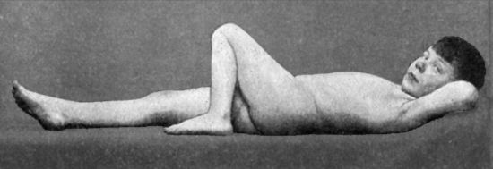 Fig. 111.—Disease of Left Hip: disappearance of lordosis on further flexion of the hip.