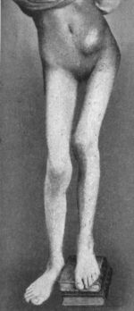 Fig. 115.—Advanced Tuberculous Disease of Left Hip-joint in a girl æt. 14, showing flexion, adduction, shortening, and iliac abscess.