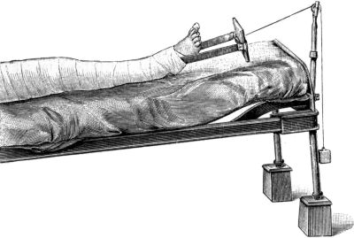 Fig. 116.—Extension by adhesive plaster and Weight and Pulley.