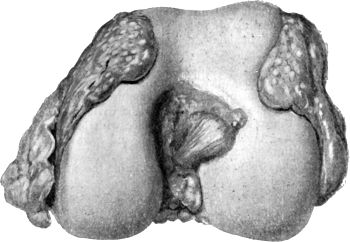 Fig. 122.—Tuberculous Synovial Membrane of Knee, spreading over articular surface of femur.