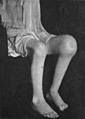 Fig. 124.—Advanced Tuberculous Disease of Knee, with backward displacement of Tibia.