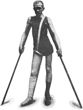 Fig. 125.—Thomas' Knee Splint applied. Note extension strapping applied to affected leg, and patten under sound foot.