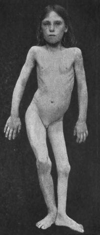 Fig. 127.—Female child showing the results of Poliomyelitis affecting the left lower extremity; the limb is short and poorly developed, the pelvis is tilted and the spine is curved.