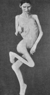 Fig. 131.—Contracture Deformities of Upper and Lower Limbs resulting from Spastic Cerebral Palsy in infancy.