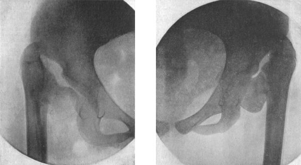 Fig. 132.—Rachitic Coxa Vara.