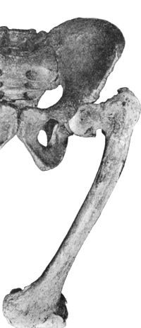 Fig. 133.—Coxa Vara, showing adduction curvature of neck of femur associated with arthritis of the hip and knee.