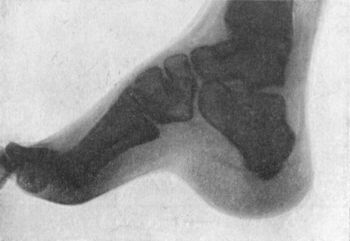 Fig. 151.—Radiogram of Foot of adult, showing the changes in the bones in Pes Cavus.