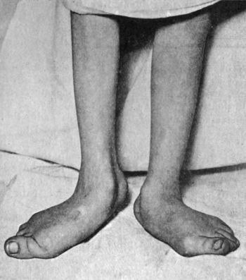 Fig. 155.—Bilateral Pes Valgus and Hallux Valgus in a girl æt. 15, the result of Anterior Poliomyelitis.