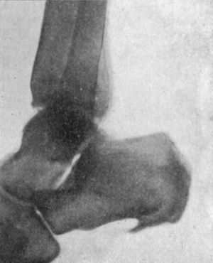 Fig. 156.—Radiogram of Spur on under aspect of Calcaneus.