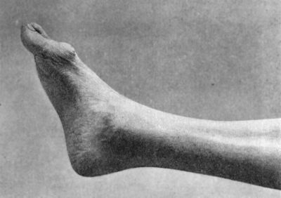 Fig. 159.—Hallux Rigidus and Flexus in a boy æt. 17. There is a suppurating corn over the head of the first metatarsal bone.