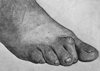 Fig. 160.—Hammer-toe.