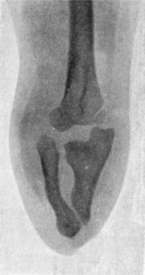 Fig. 169.—Radiogram of Arm of patient shown in Fig. 168.