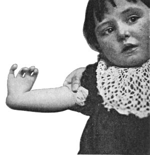 Fig. 171.—Club-hand, the result of imperfect development of radius. The thumb is absent.