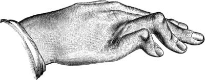 Fig. 172.—Congenital Contraction of Ring and Little Fingers.