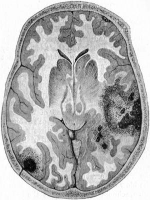 Fig. 184.—Contusion and Laceration of Brain. Note limited lesion at point of impact on left side, and more extensive damage at point of contre-coup on right.