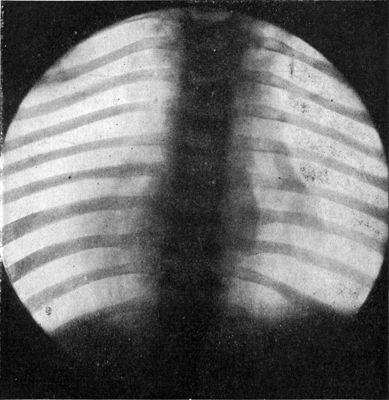 Fig. 213.—Radiogram of Child's Thorax, showing spindle-shaped shadow at site of Pott's disease of fourth, fifth, and sixth thoracic vertebræ.