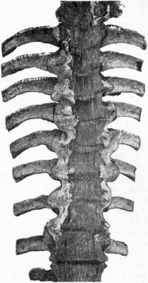 Fig. 218.—Arthritis Deformans of Spine. The vertebræ are fixed to one another by outgrowths of bone which bridge across the intervertebral spaces, and there is a slight lateral deviation to the left in the mid-dorsal region.