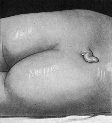 Fig. 222.—Tail-like Appendage over Spina Bifida Occulta in a boy æt. 5, and associated with incontinence of urine. Operation was followed by temporary retention.