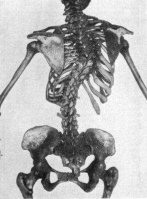 Fig. 228.—Scoliosis with primary curve in Thoracic Region.